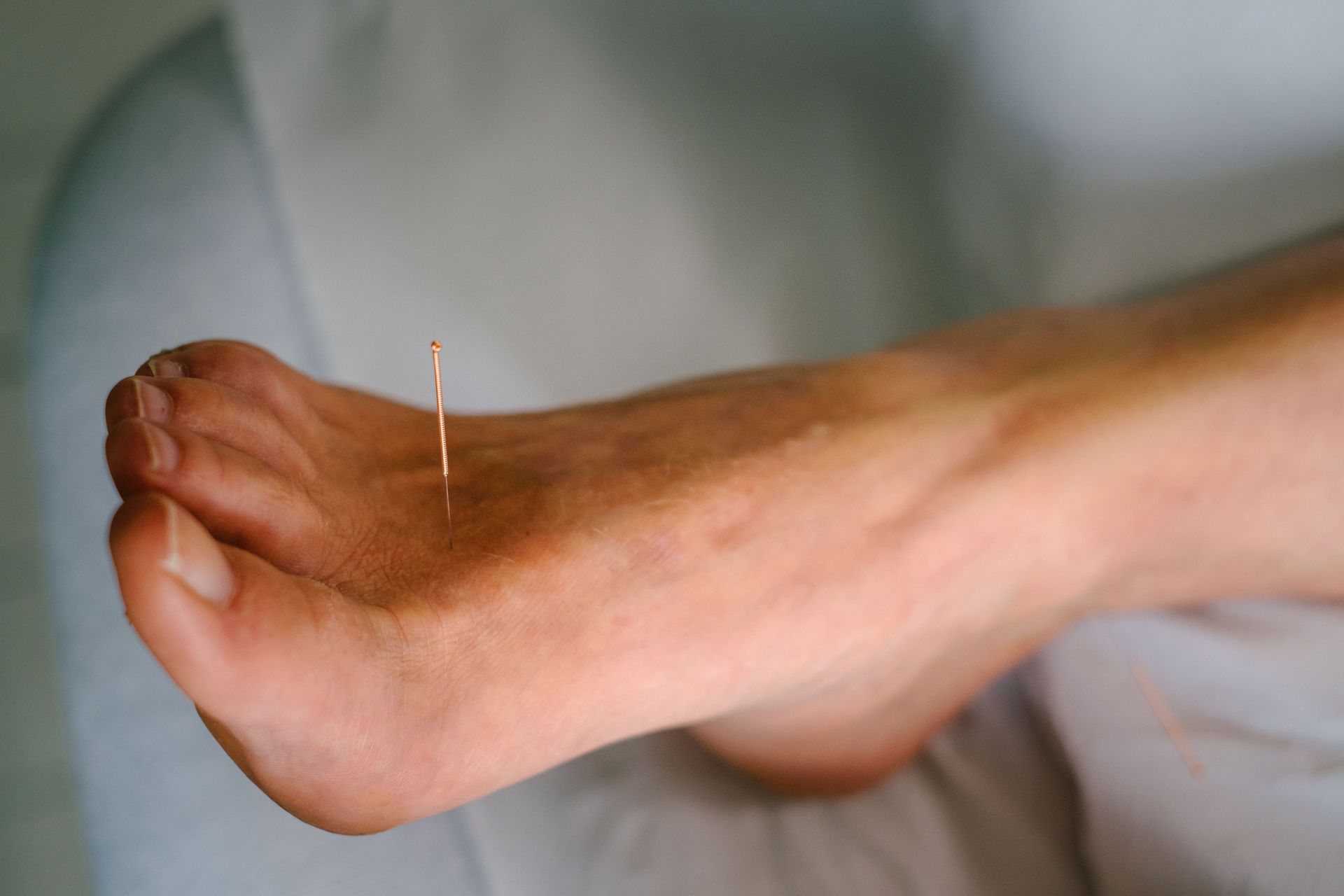 Acupuncture